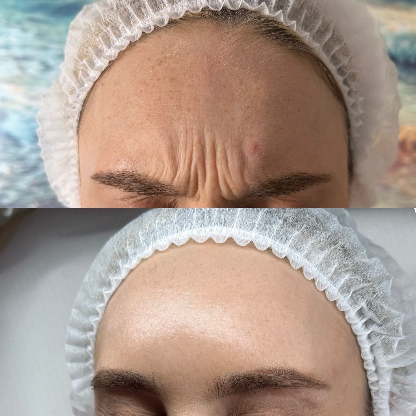 لاین تزریق بوتاکس